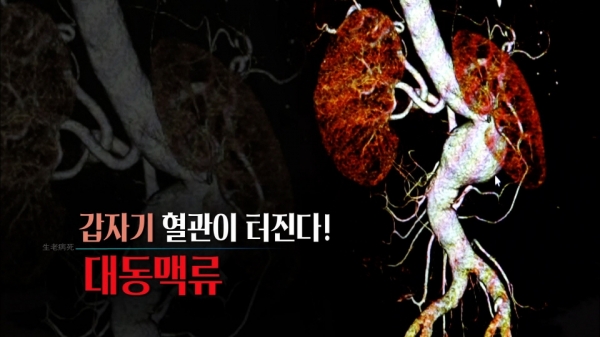 [생로병사의 비밀] 대동맥류, 갑자기 혈관이 터진다