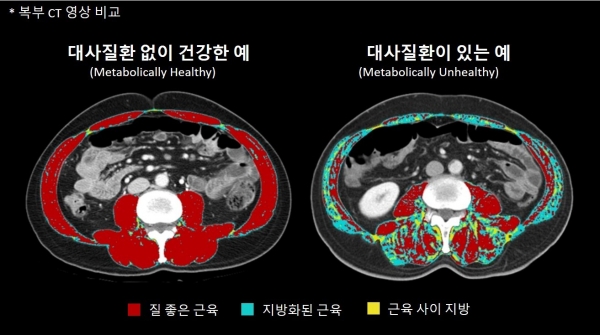 질좋은 근육과 대사질환 위험 연관성 연구-서울아산병원 제공